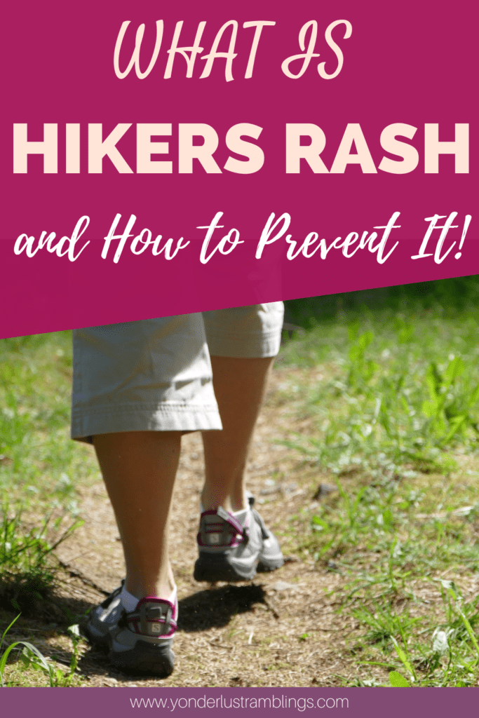 Hikers rash and hikers rash treatment