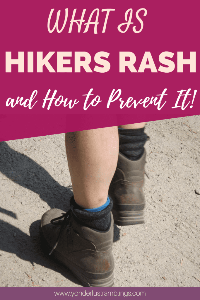 Hikers rash and hikers rash treatment